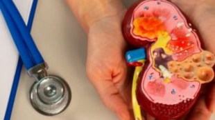 Kidney Disease | Health Tips