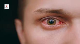 Conjunctivitis (Image Credits Pixabay)