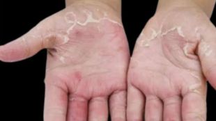 Peeling Skin tips