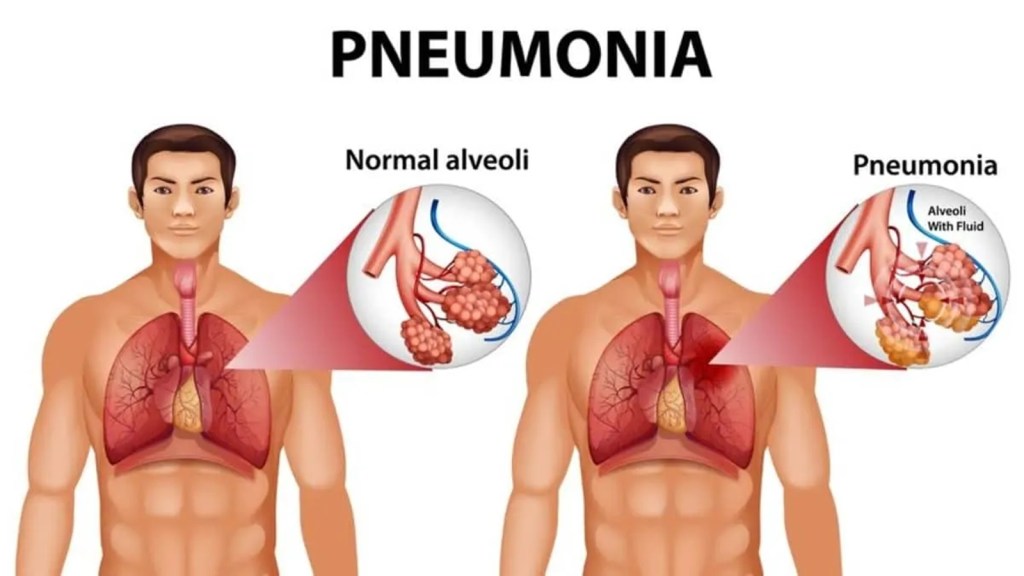 Pneumonia | Pneumonia Diet Tips | Pneumonia Health Tips | how to recover quickly from pneumonia | cough remedies