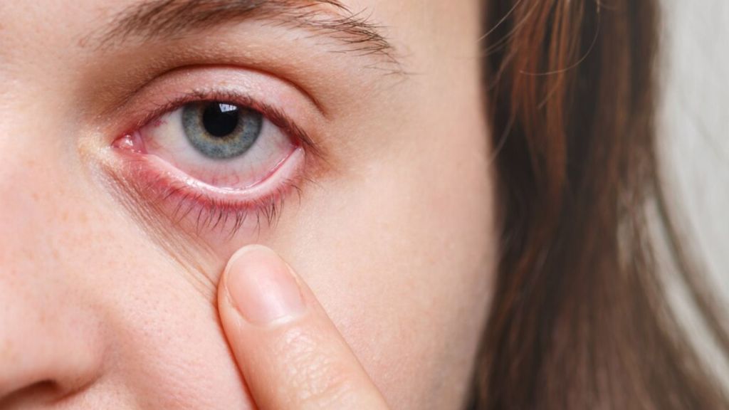 conjunctivitis | conjunctivitis tips | how to take care of conjunctivitis