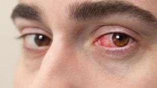Conjunctivitis