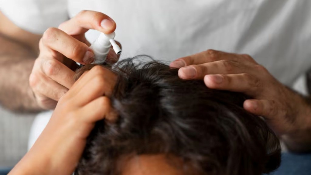 Scalp fungal infection, Monsoon season, hair care