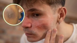 How To Remove Black Spots From Face