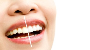 alum for teeth whitening